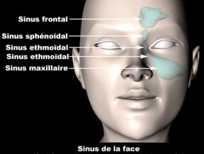 Inflammation des sinus nasaux, Sinusite