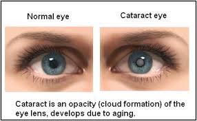 Cataracte