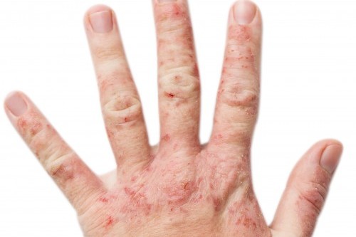 eczema-mains