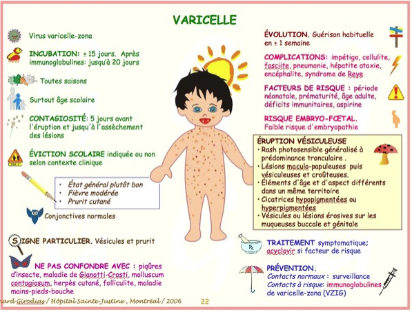 La Varicelle M decine Int gr e