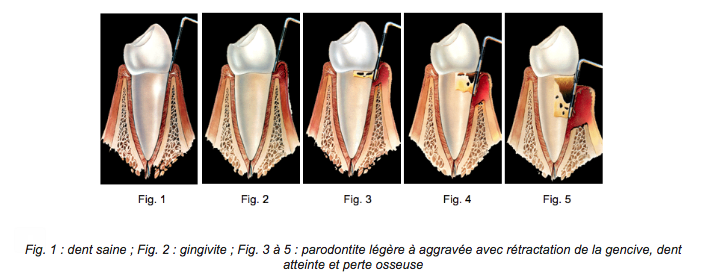 Parodontites / Parodontoses Médecine Intégrée