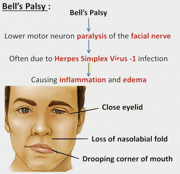 Paralysie faciale - Médecine Intégrée