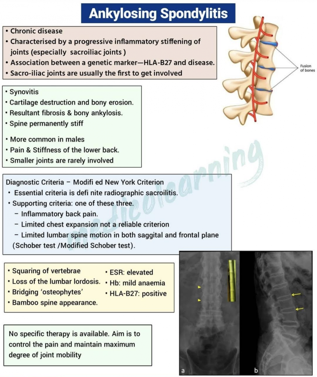 Spondylarthrite ankylosante - Médecine Intégrée