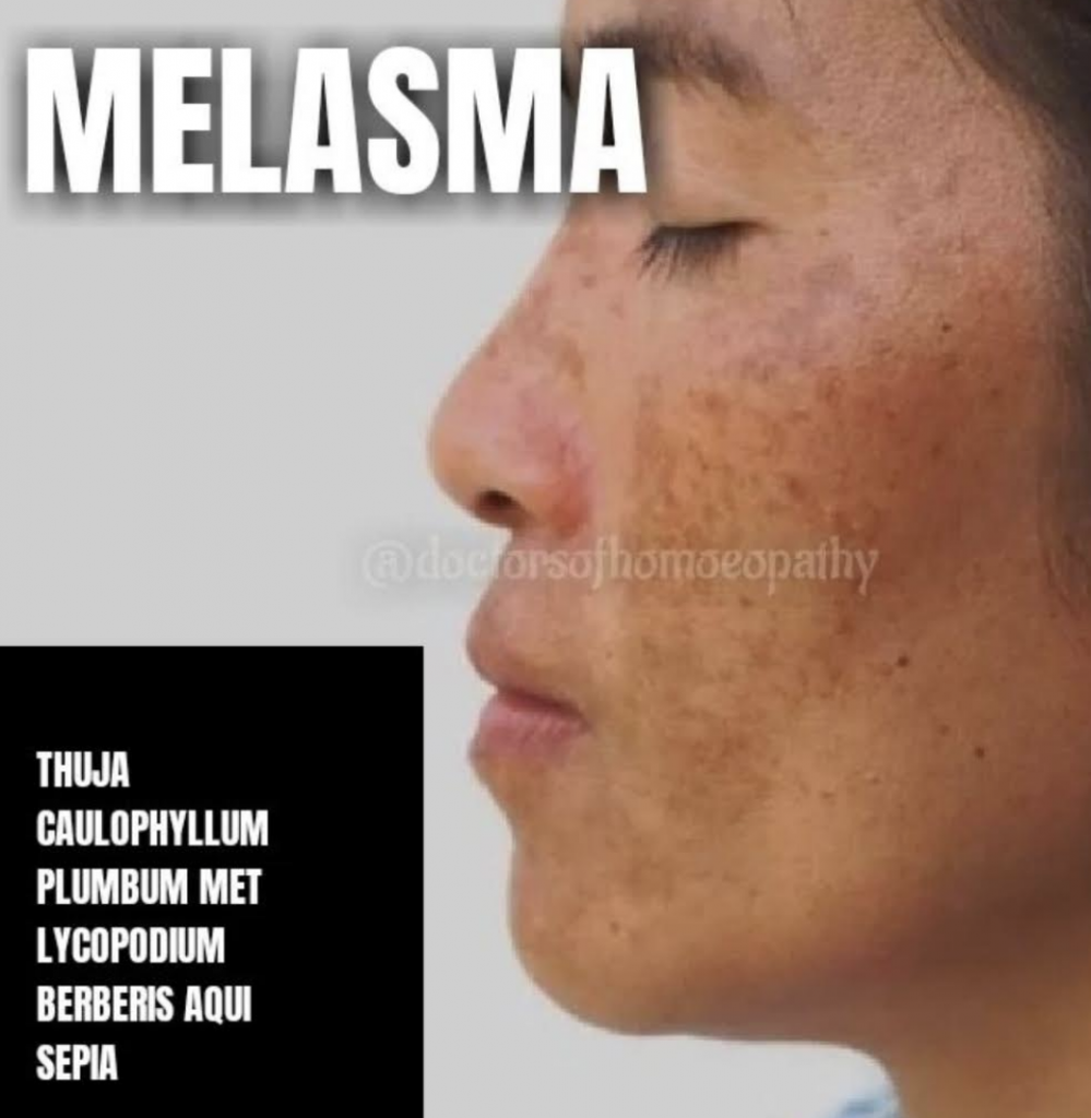 Melasma - Médecine Intégrée