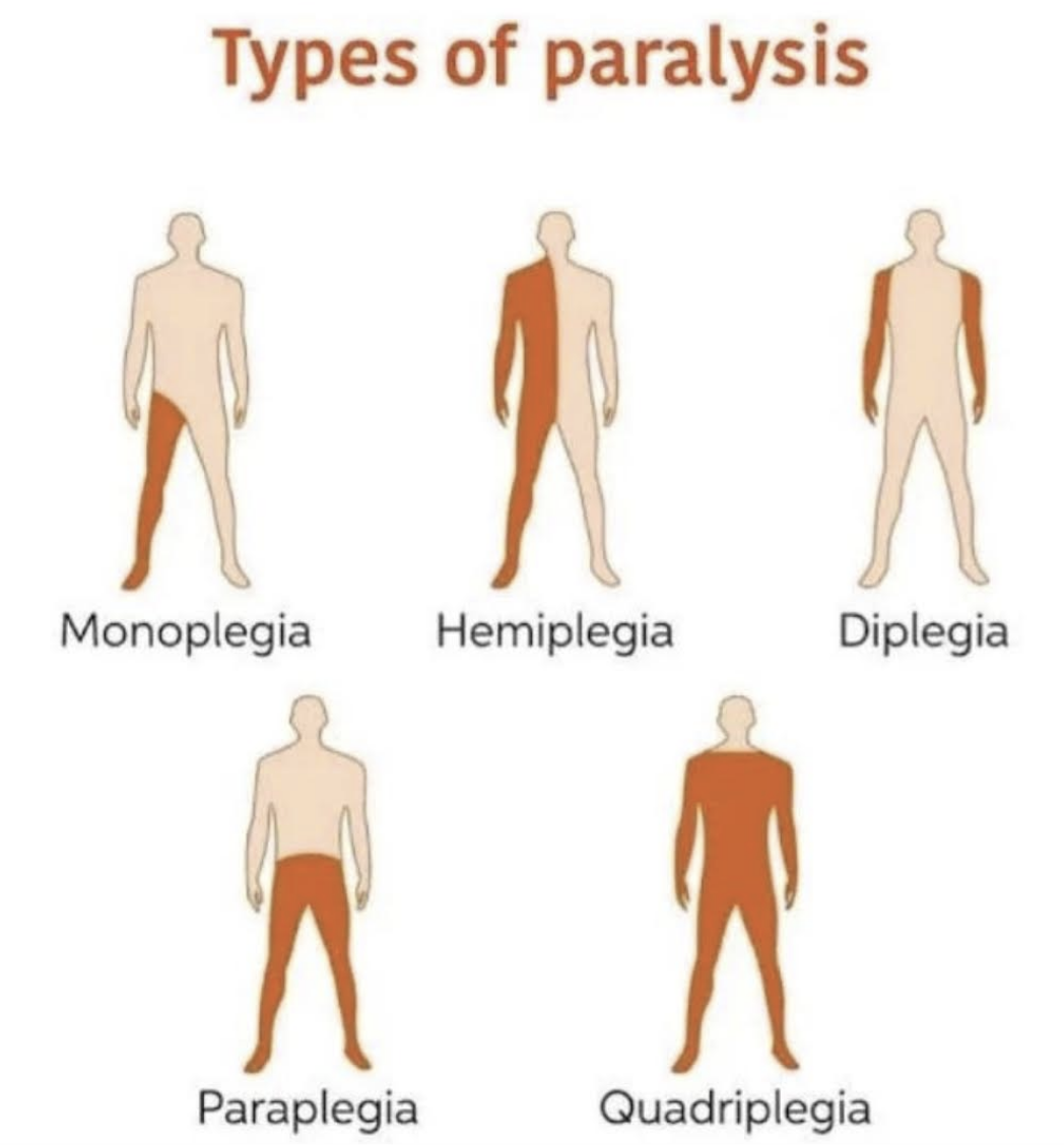 Les paralysies - Médecine Intégrée